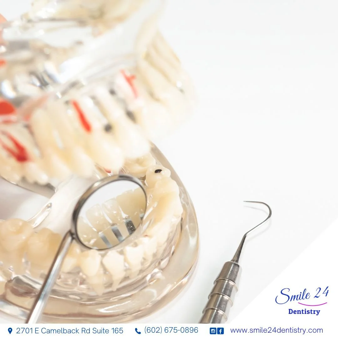 Dentist Root Canal in Phoenix