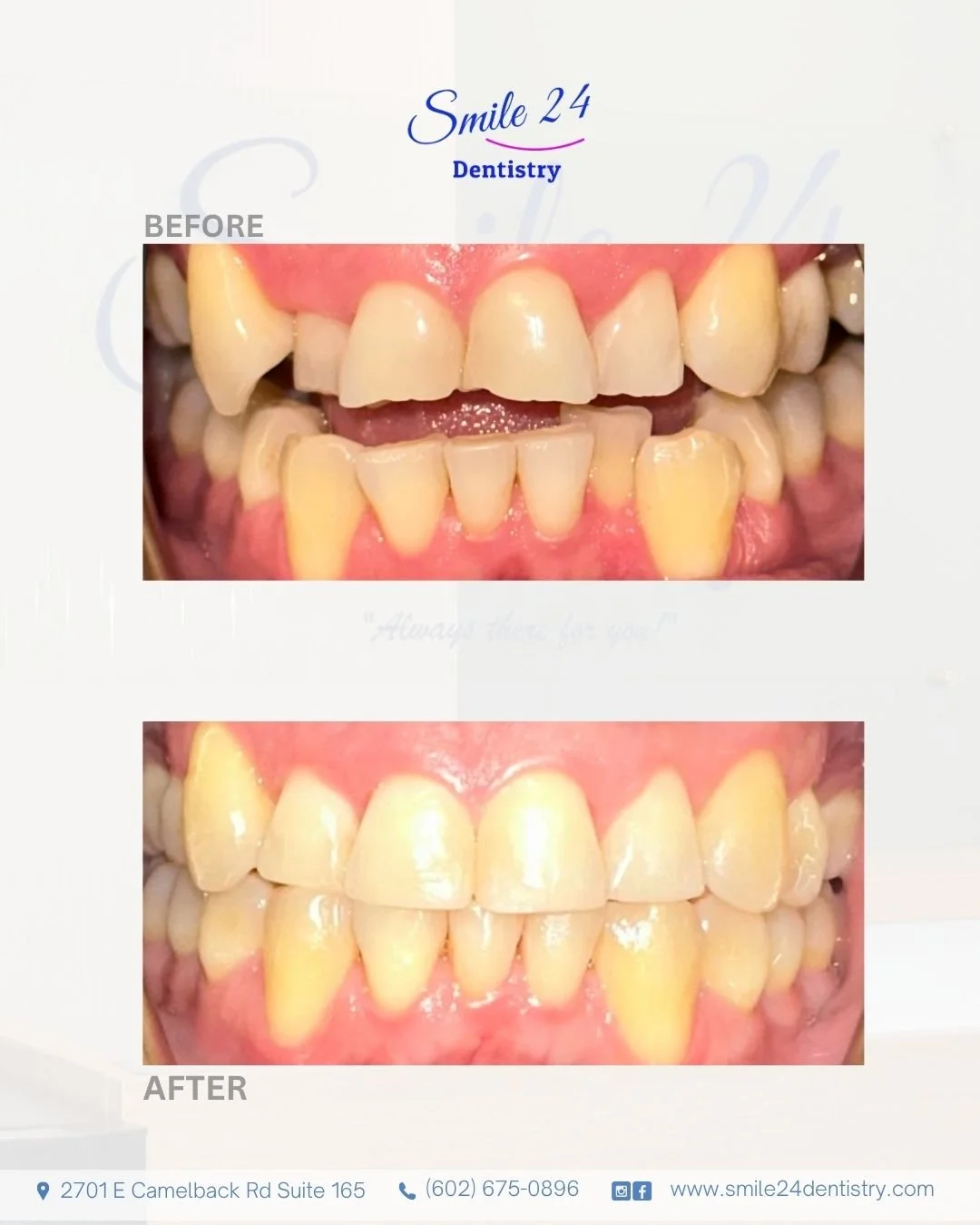 teeth straightening with clear aligners in Phoenix Scottsdale Paradise Valley Az