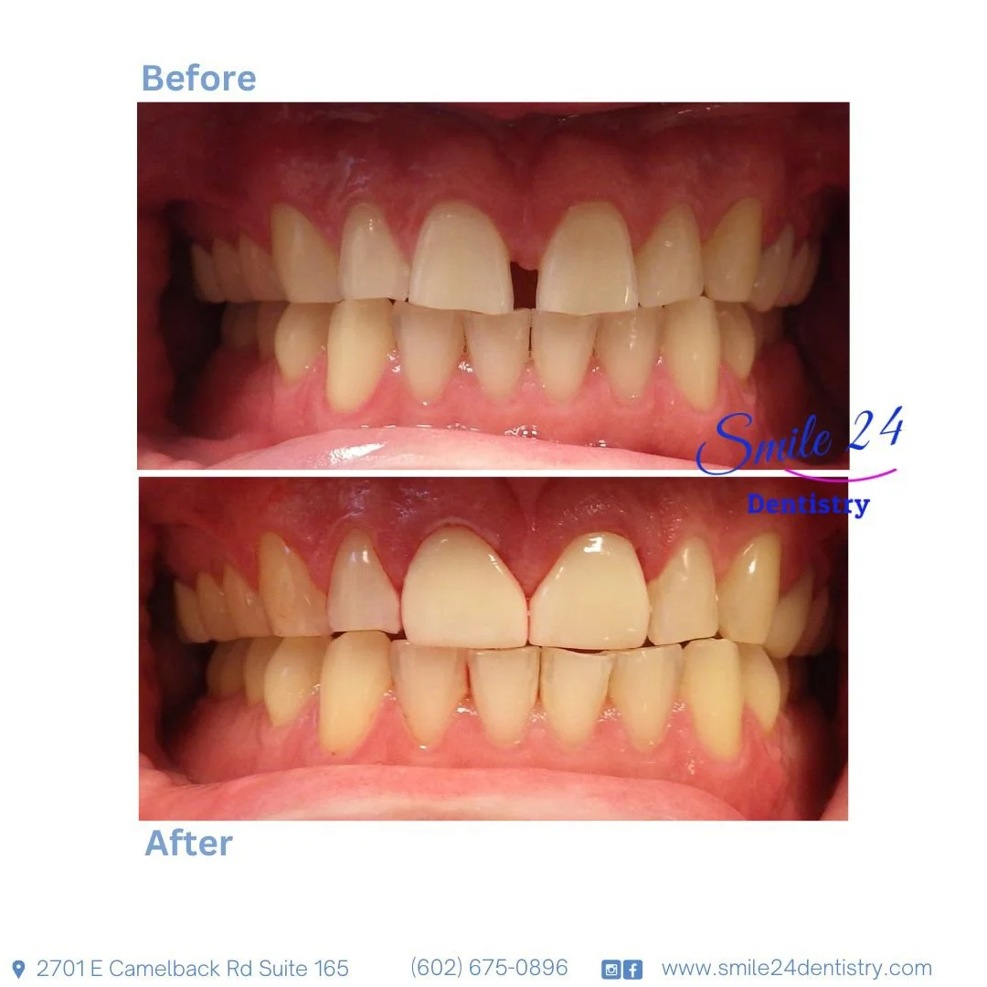 Smile Makeover in Phoenix, AZ Before and After