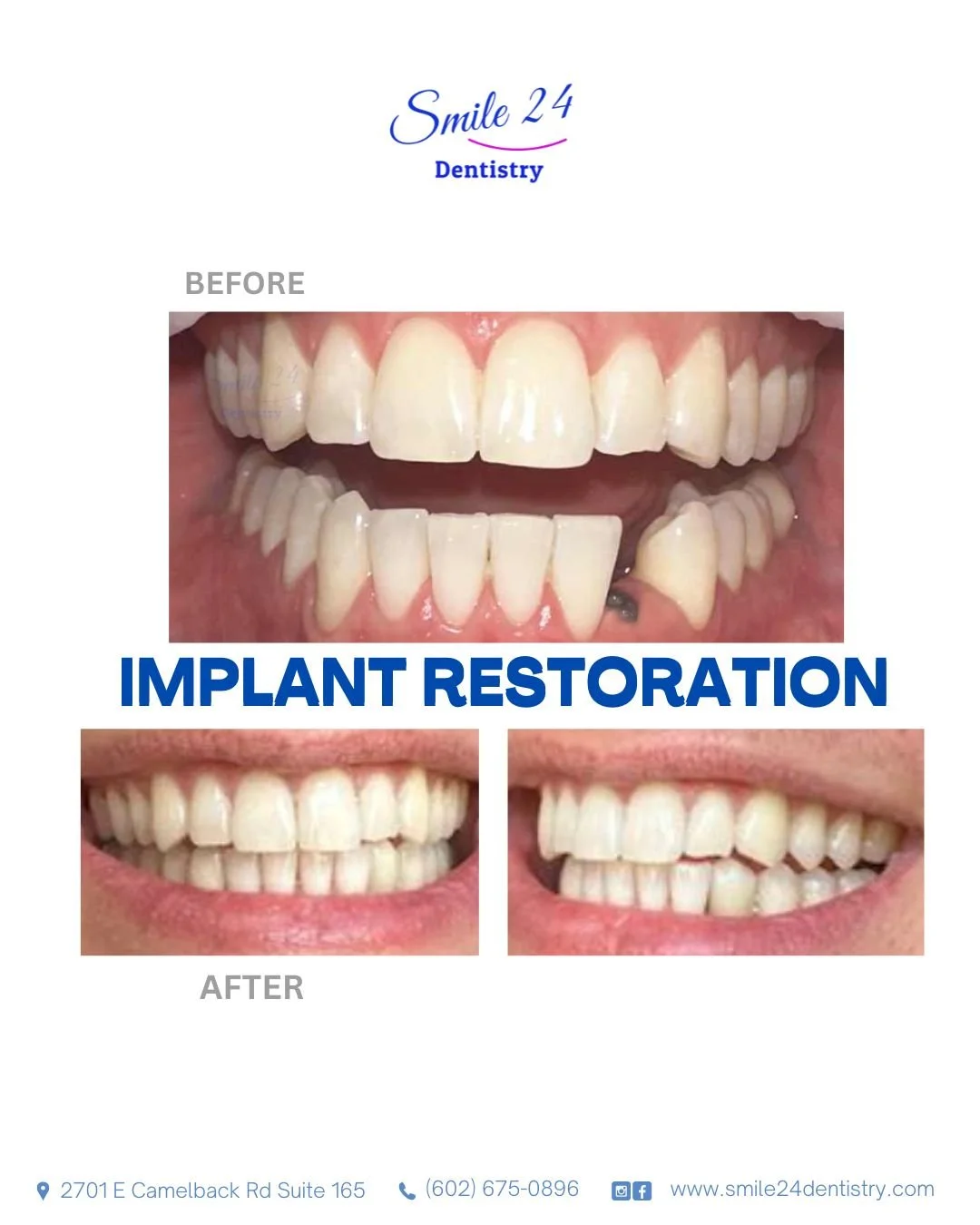 Dental implant restoration Before and after