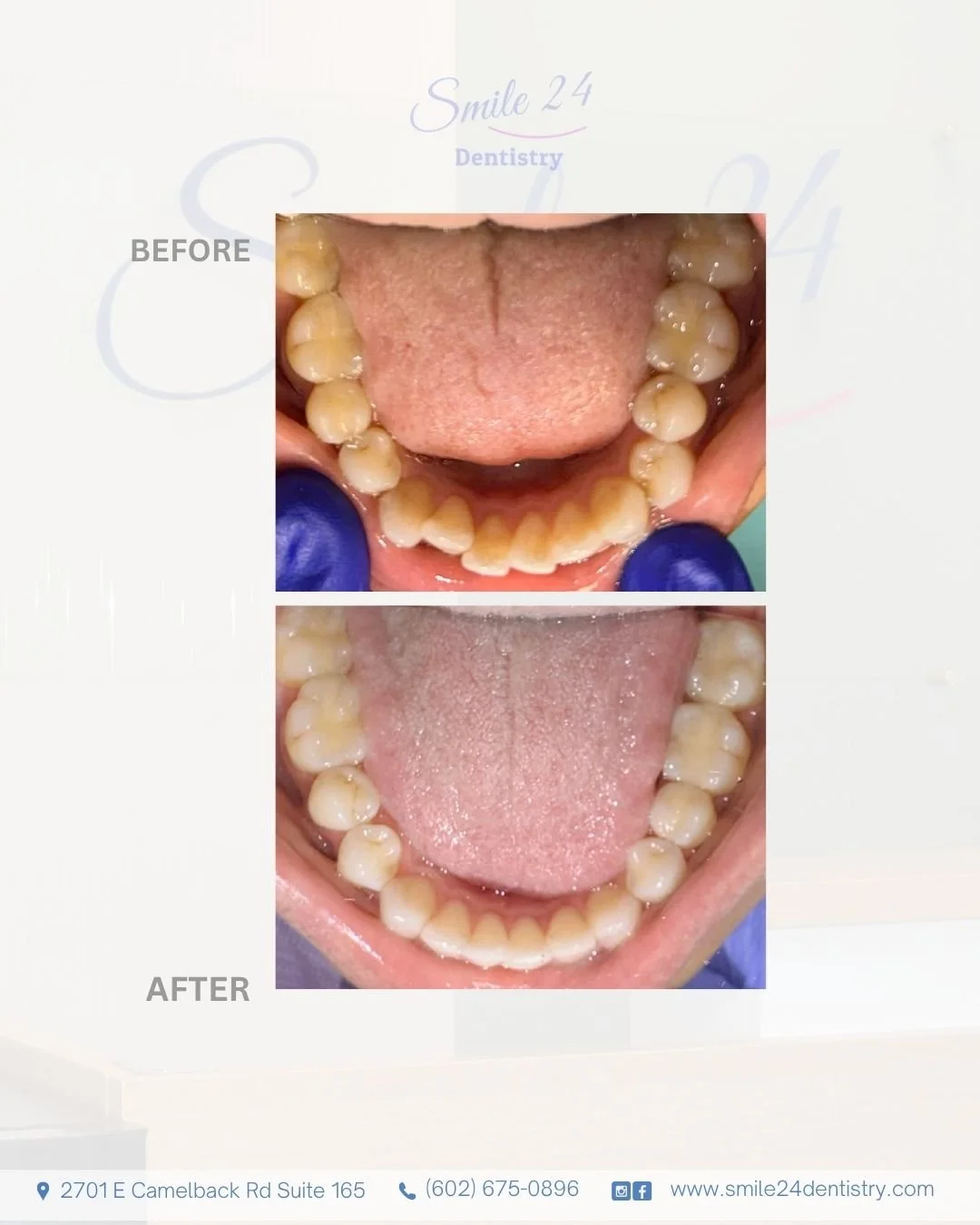 Teeth straightening with clear aligners in Phoenix Az