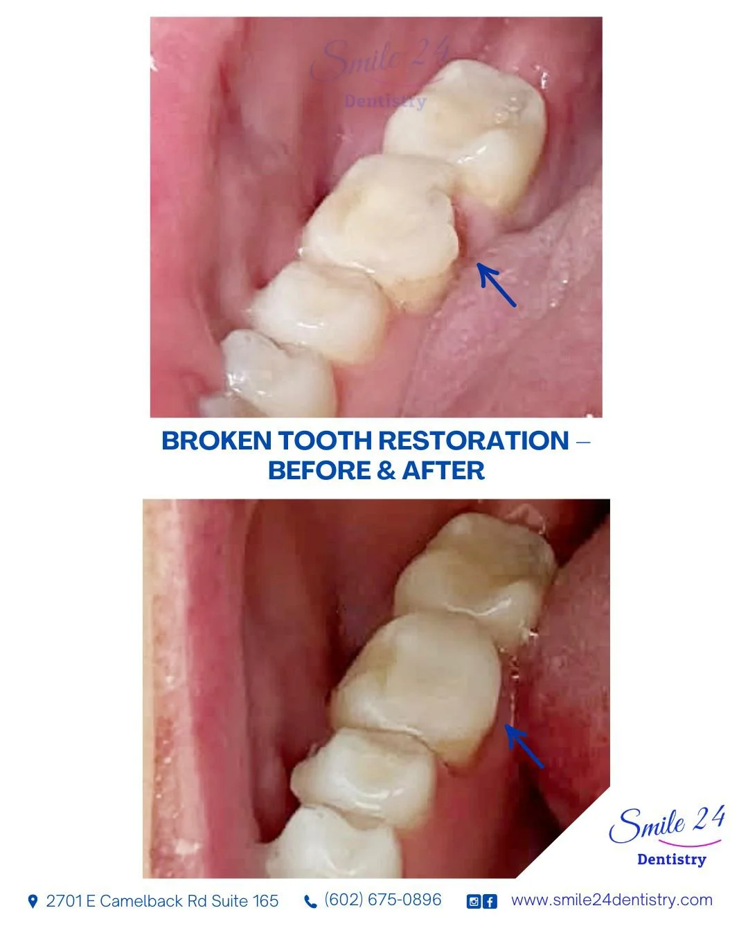 Broken Tooth Restoration at Smile 24 Dentistry in Phoenix AZ: Before & After