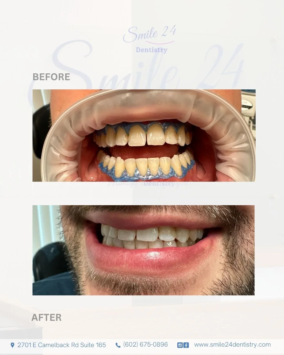 In office Teeth Whitening by Smile 24 Dentistry Phoenix Biltmore area: Before&After