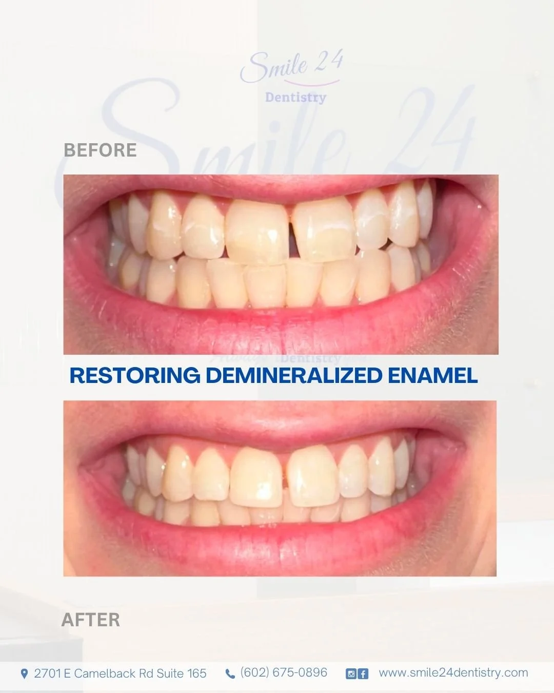 Enamel Restoration After Orthodontics