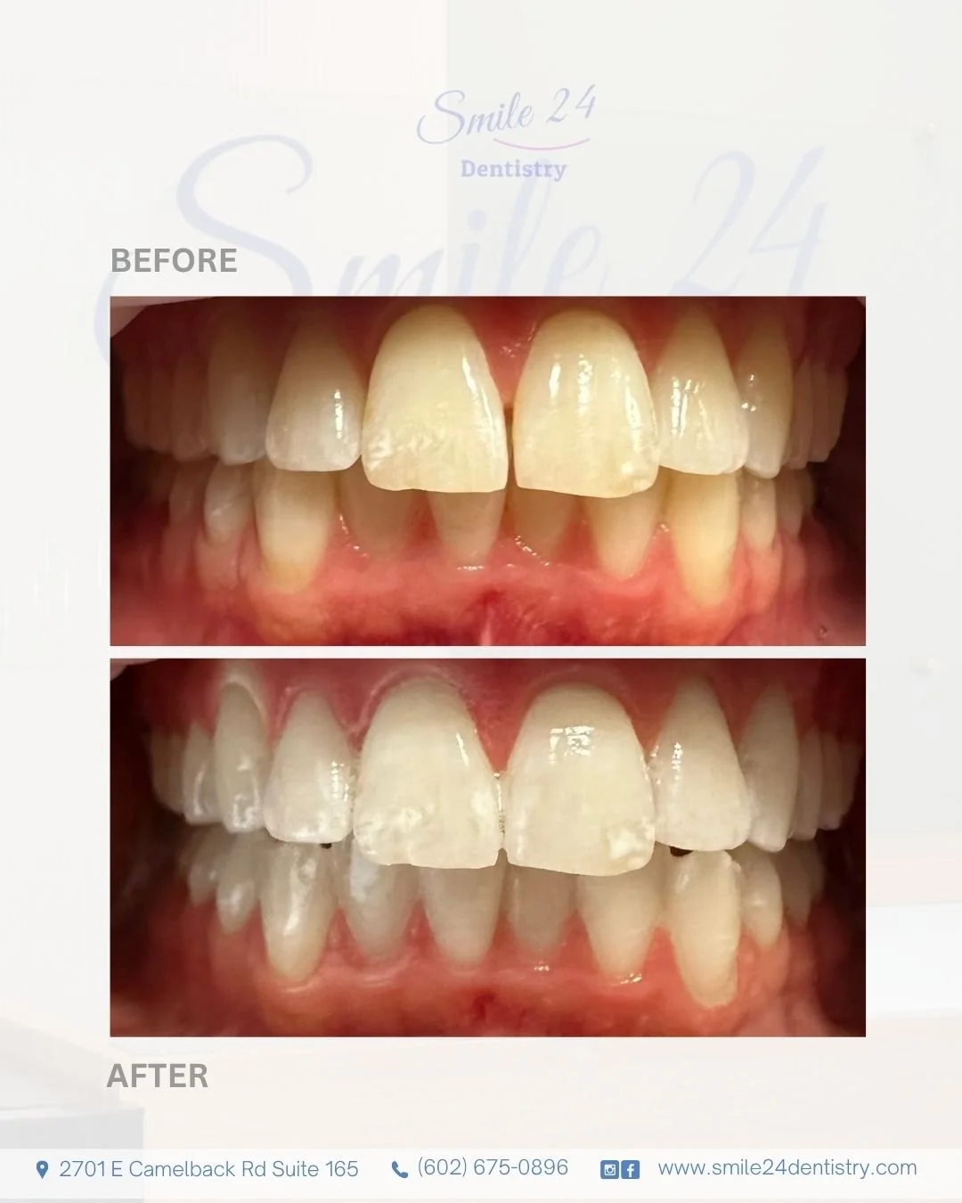 In office Teeth whitening by Smile 24 Dentistry Phoenix Biltmore area Az.jpg