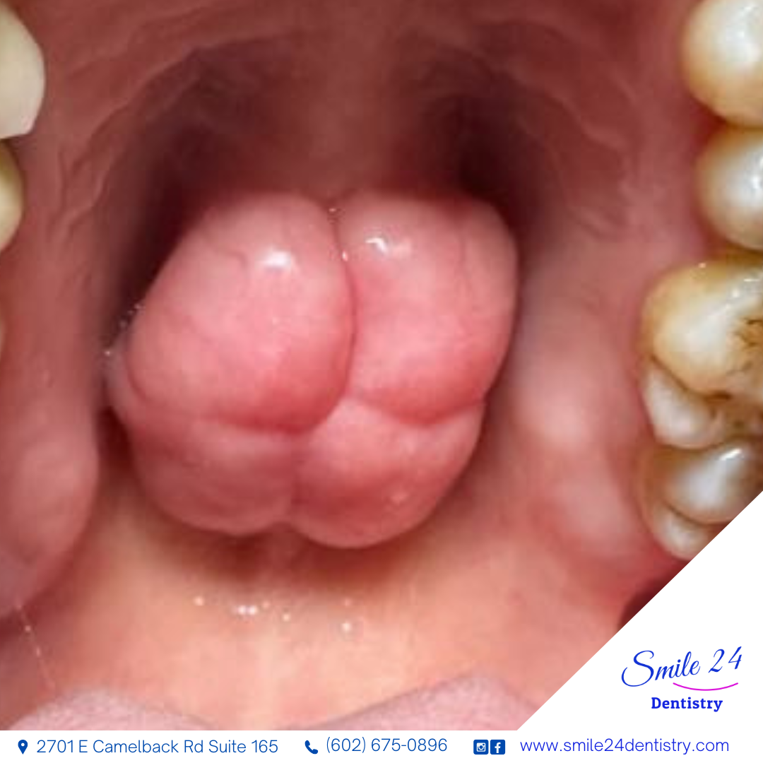 Mouth Tori or Dental Tori