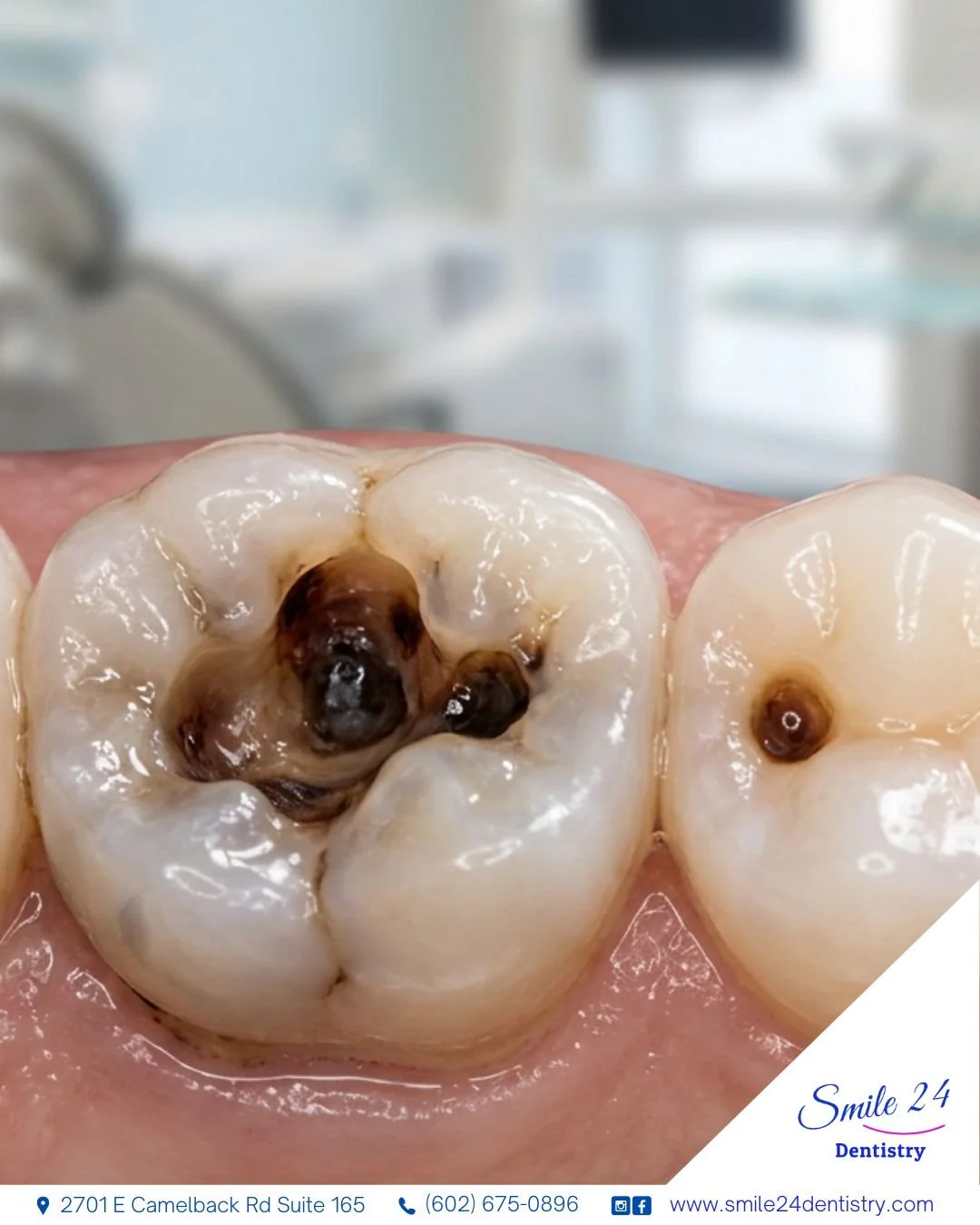 What happens when you ignore a cavity