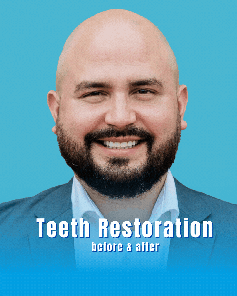 Teeth Restoration Before and After at Smile 24 Dentintistry in Phoenix, Az Biltmore area