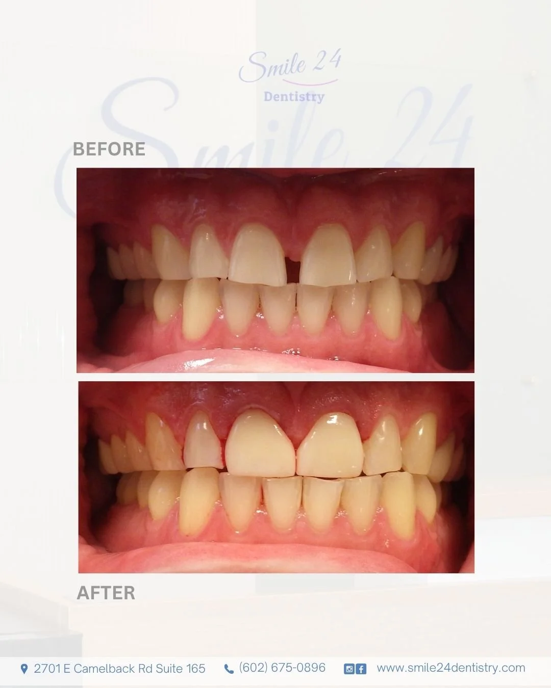 Smile Transformation Before and After by Smile 24 Dentistry in Phoenix, Az, Biltmore area