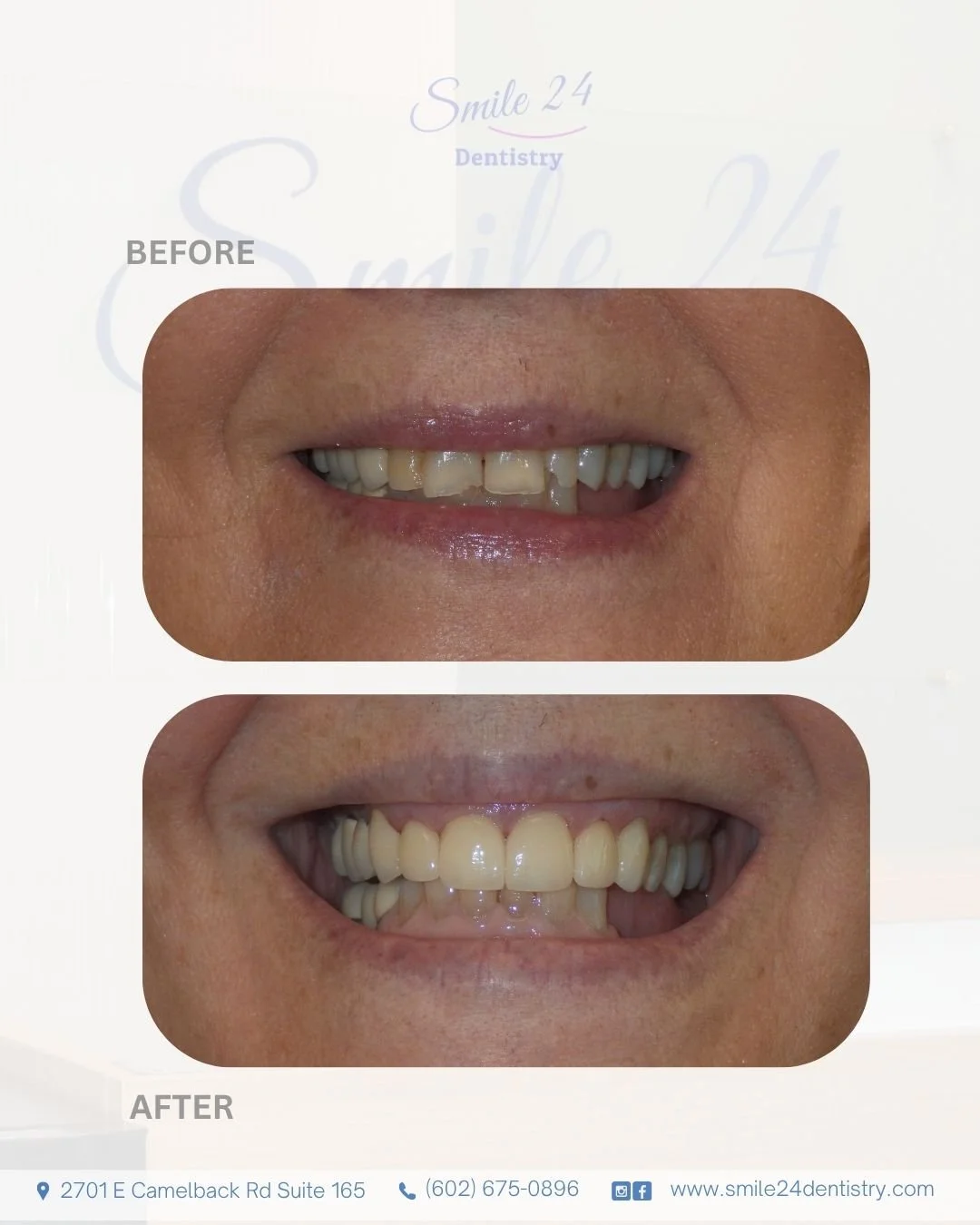 Smile Makeover Before and After by Smile 24 Dentistry in Phoenix, Az, Biltmore area
