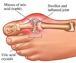 gout.jpg