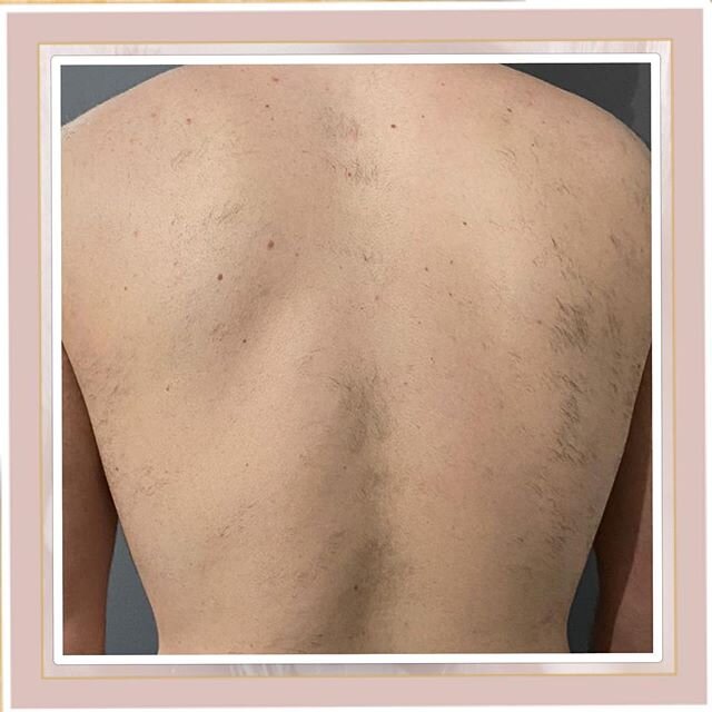 I love a progress photo. This time for hair removal. Pow pow and the hairs are gone. The client has had four session of our SHR. As you can see the hairs are almost gone after just four &hearts;️🌴