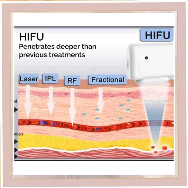 Is HIFU for you?