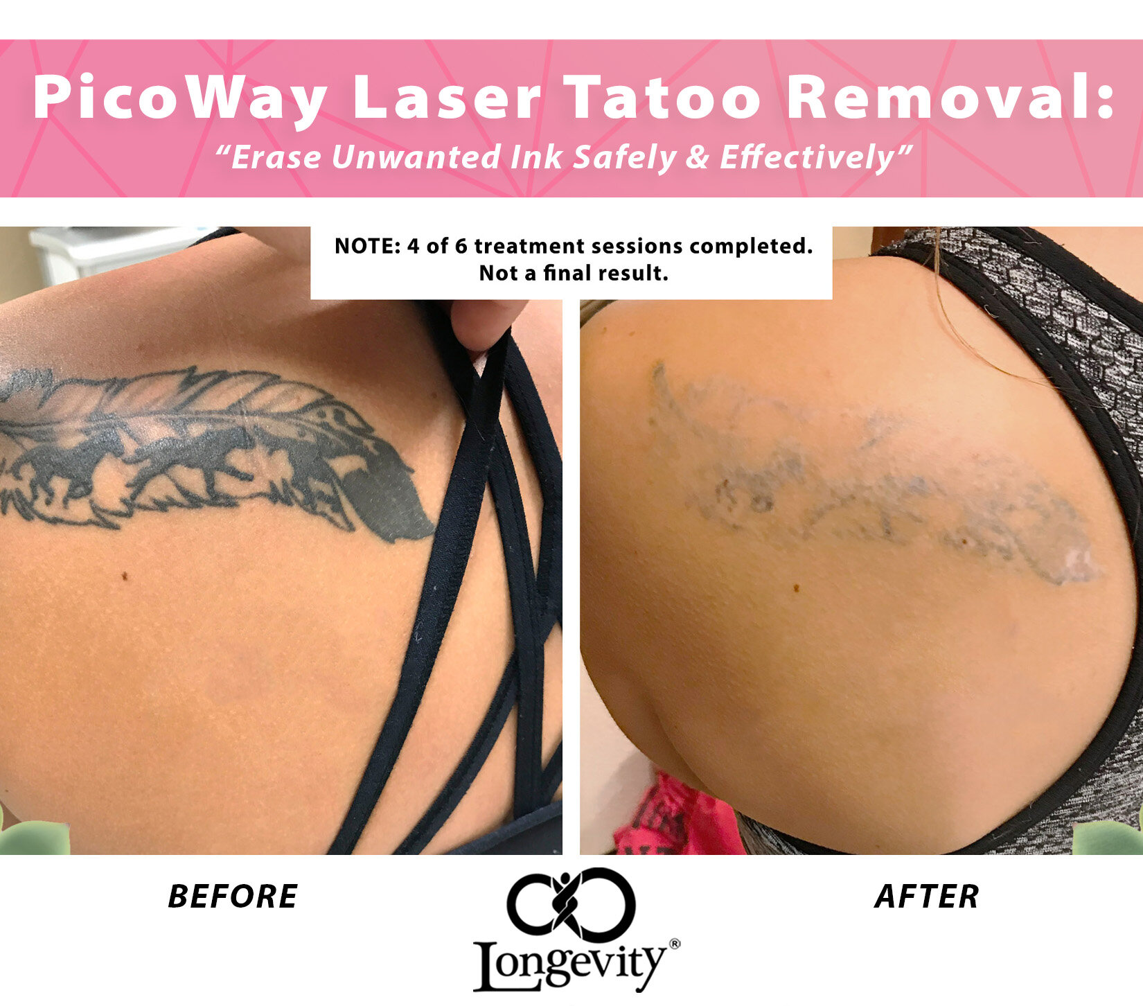 Tattoo removal new PicoWay laser for better results