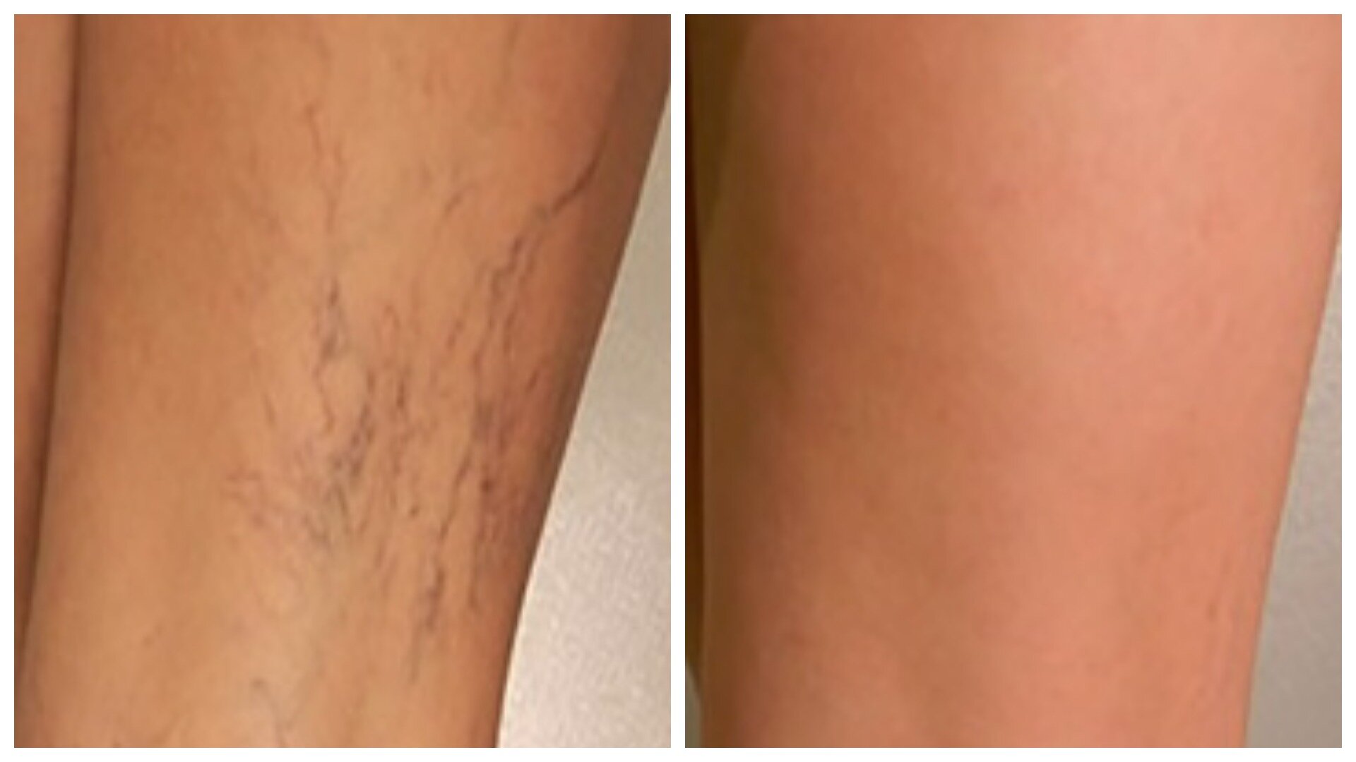 Thread vein removal inner thigh