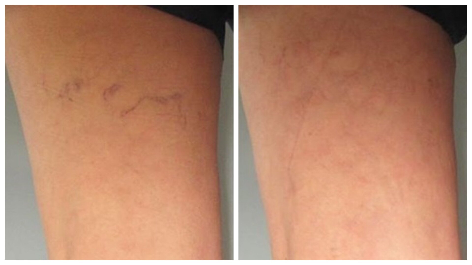 Thread vein removal back of upper thigh