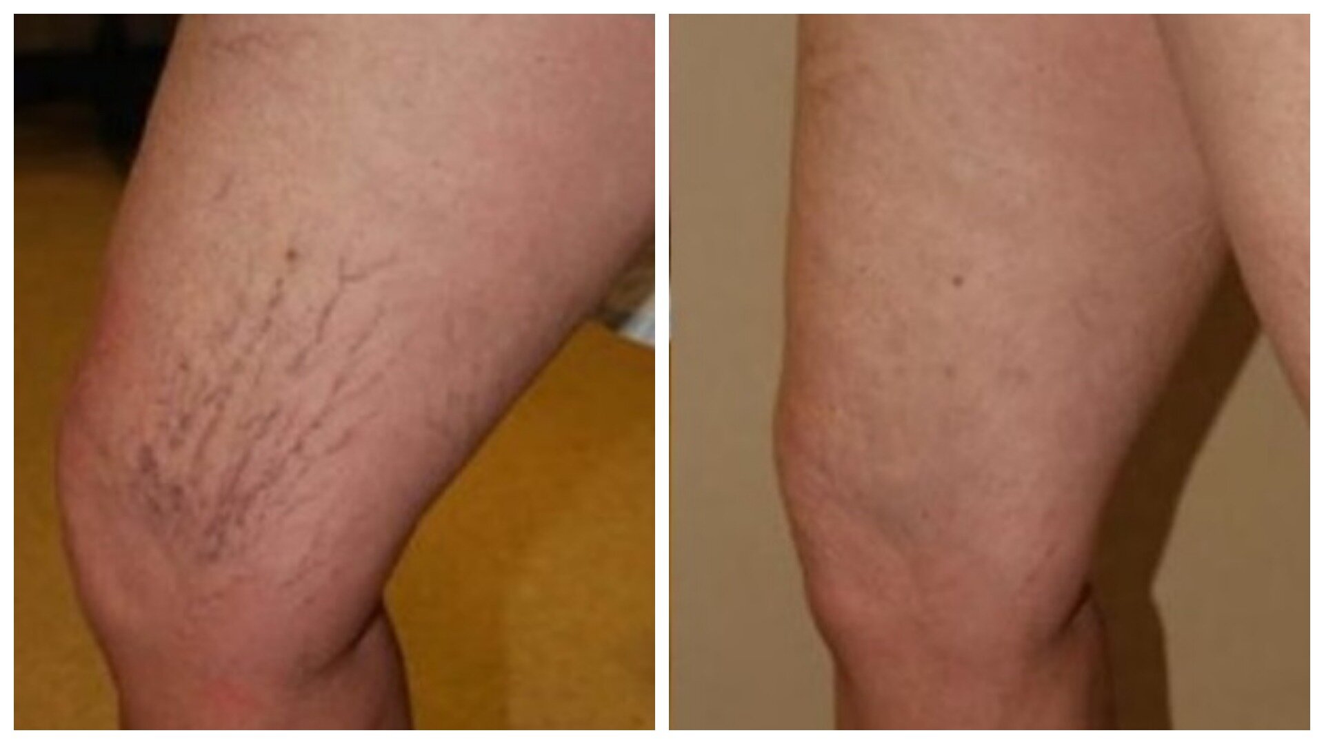 Spider vein removal from legs