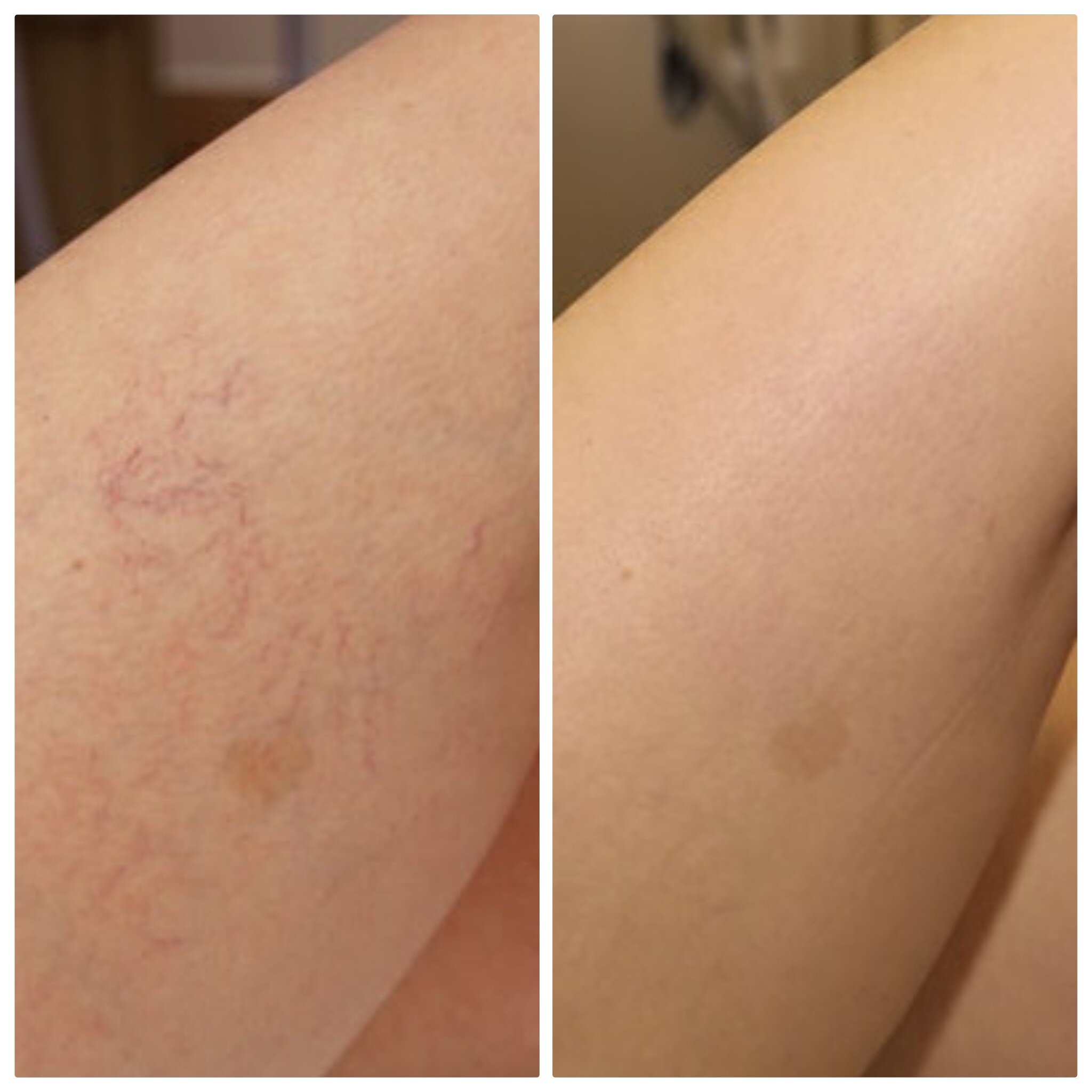 Spider vein removal outer thigh