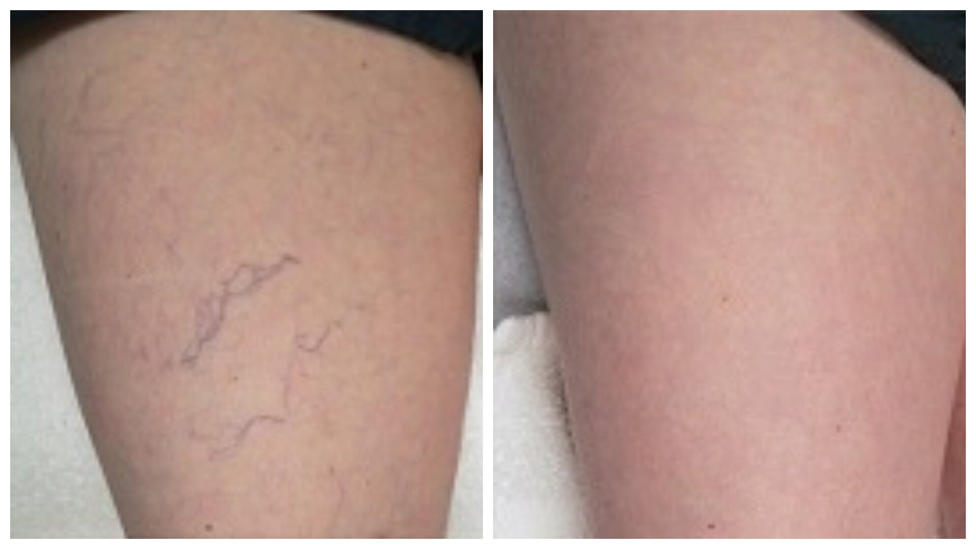 Spider vein removal front thigh