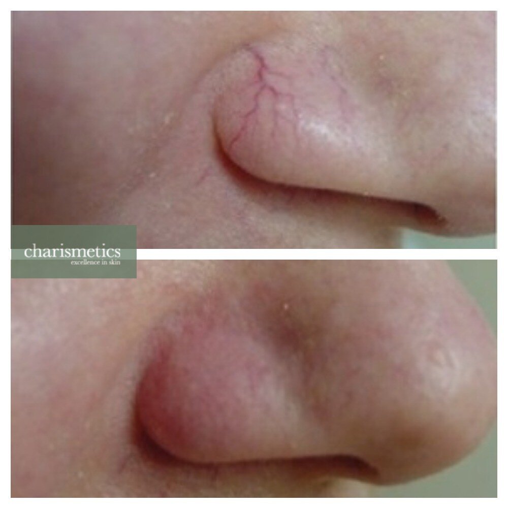 Thread vein removal from nose