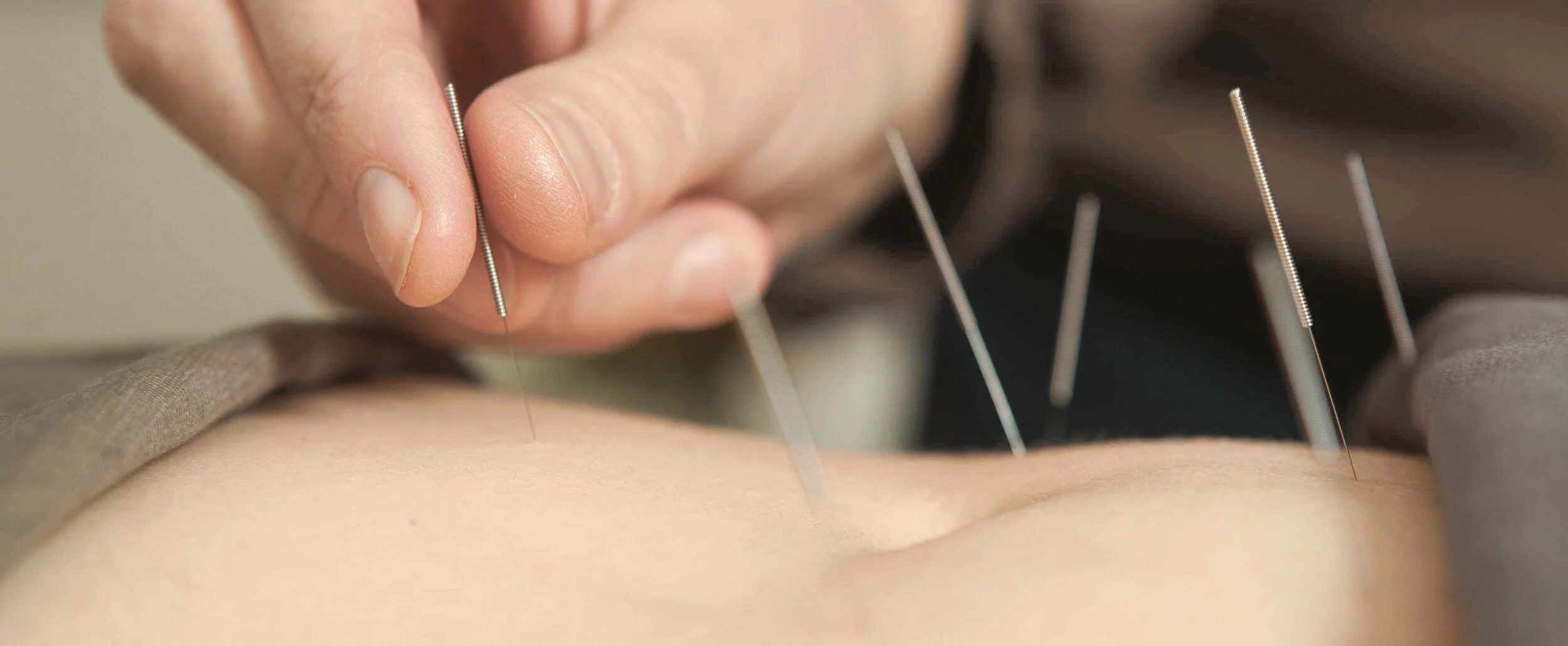 acupuncture_3.jpg