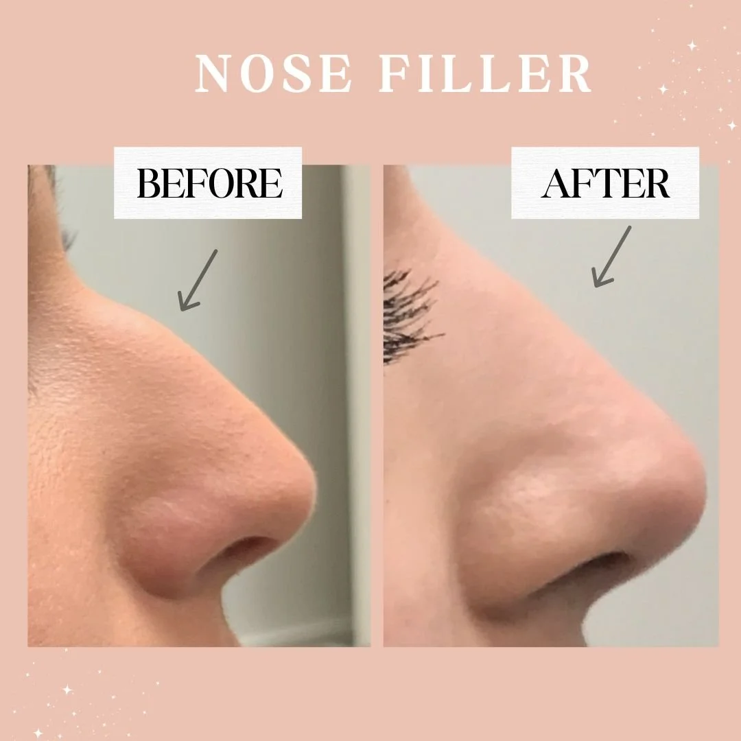 Nose fillers near me