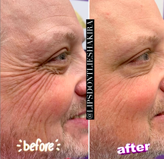 Jules botox crow lipsdontlieshakira 5.png
