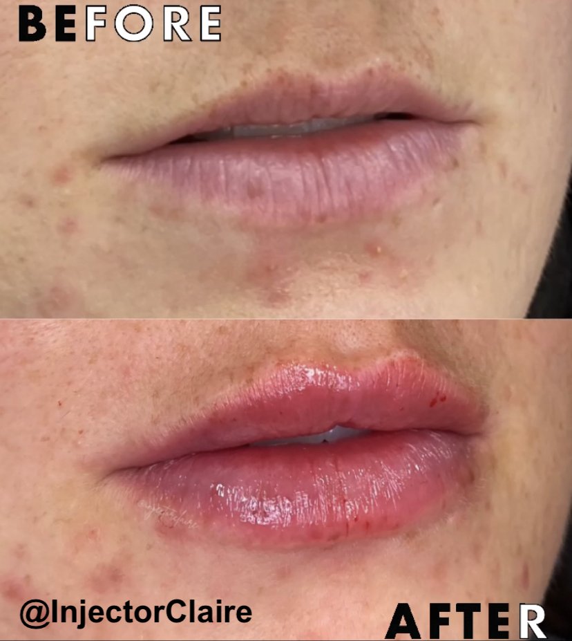 Lips by Claire Bassler RN