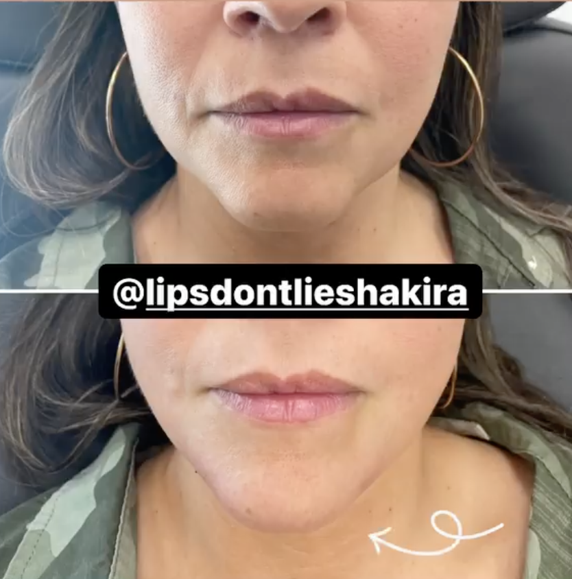 Chin Filler.png