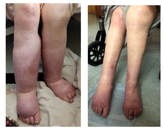 stage 2 lymphedema before and after progress photos to show that complete decongestive therapy works well.png