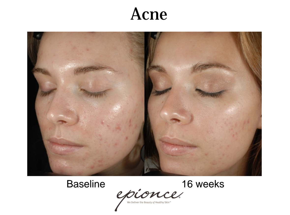 epionce-peel-acne.png