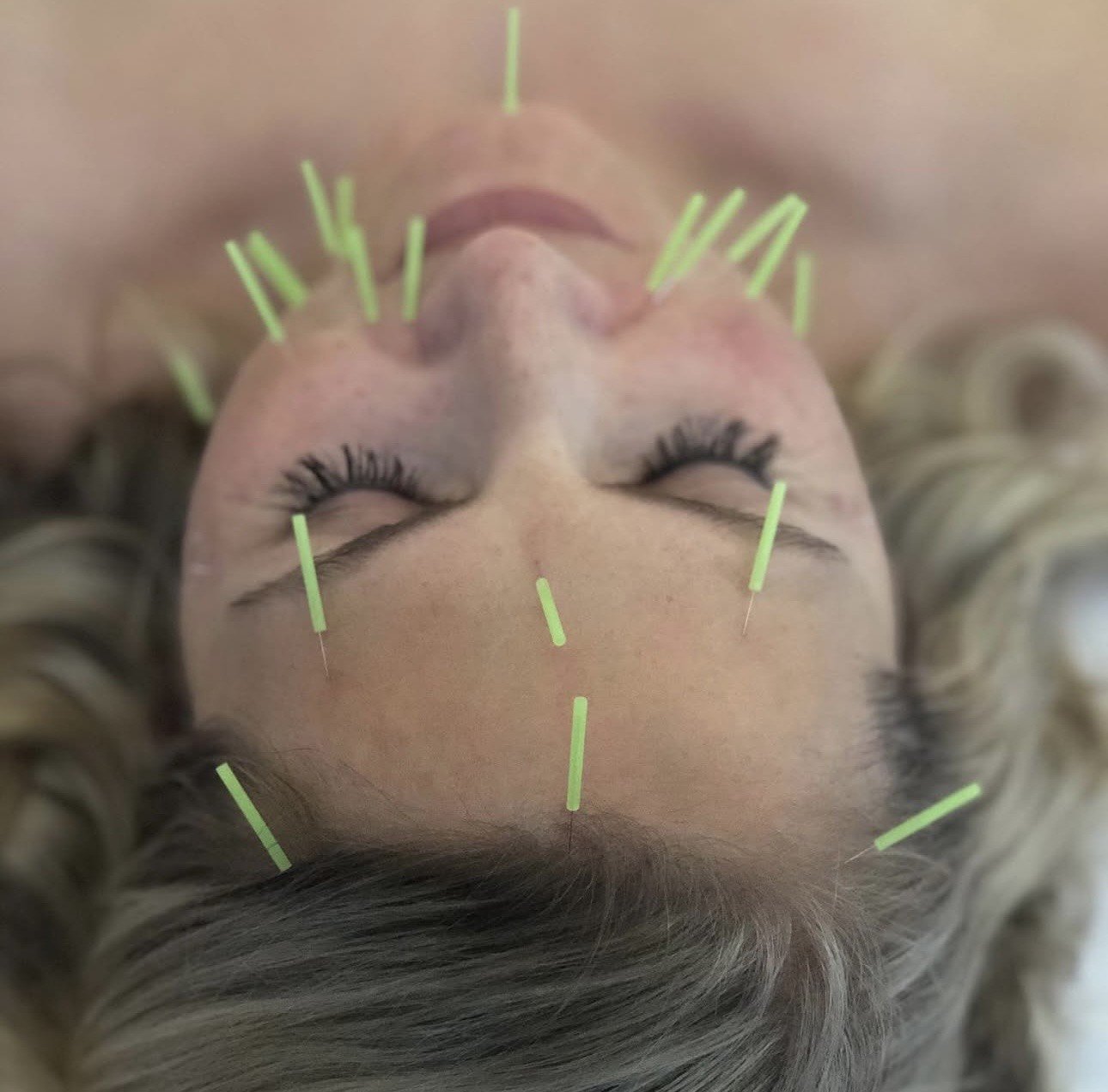 La beauté de l’acupuncture cosmétique