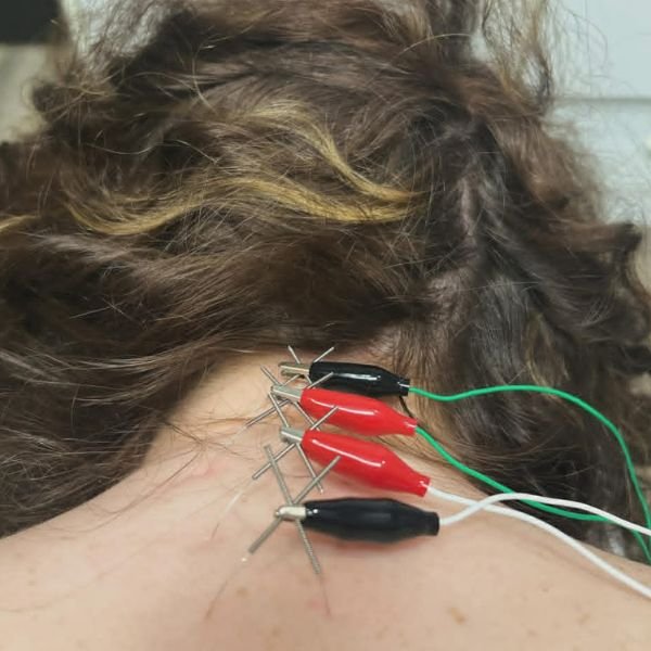 L’acupuncture pour les douleurs physique et la mobilité