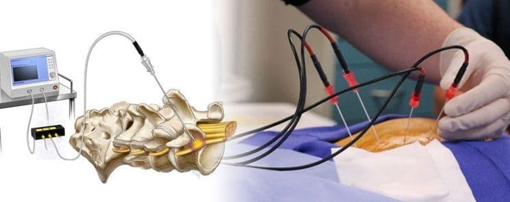 Radiofrequency Ablation