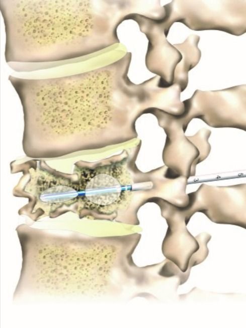 Kyphoplasty