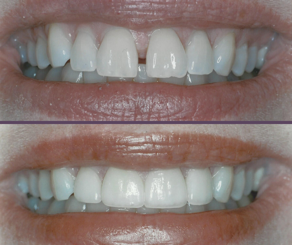 Veneers