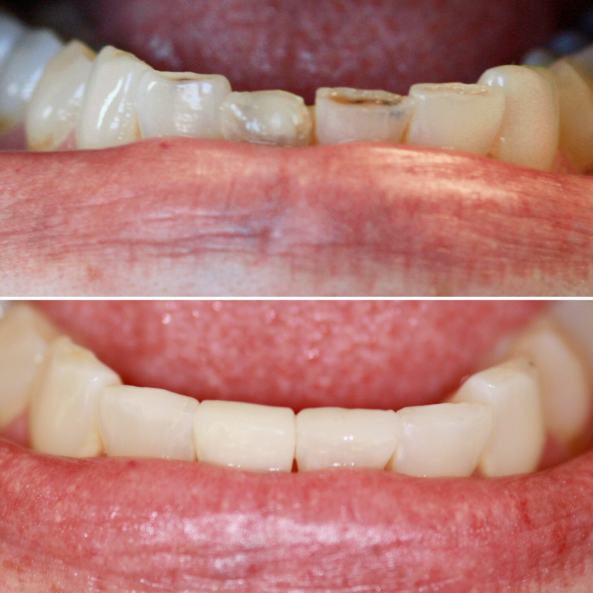 Composite Fillings