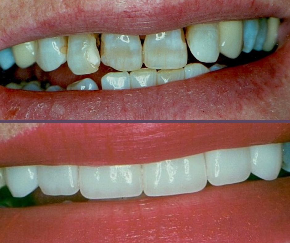 Veneers