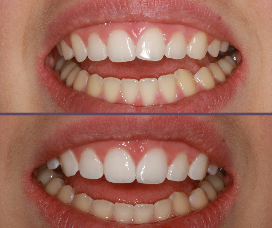 Composite Veneers