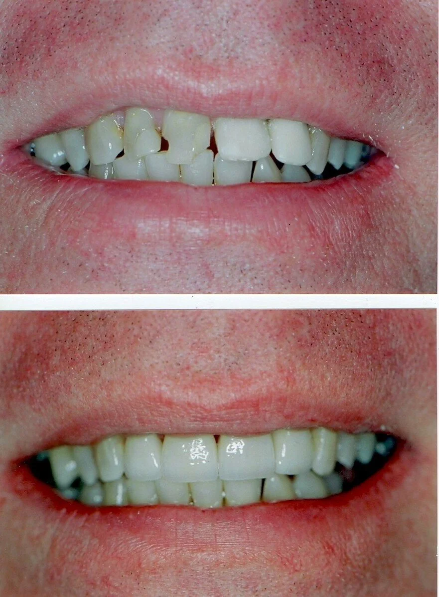 Veneers