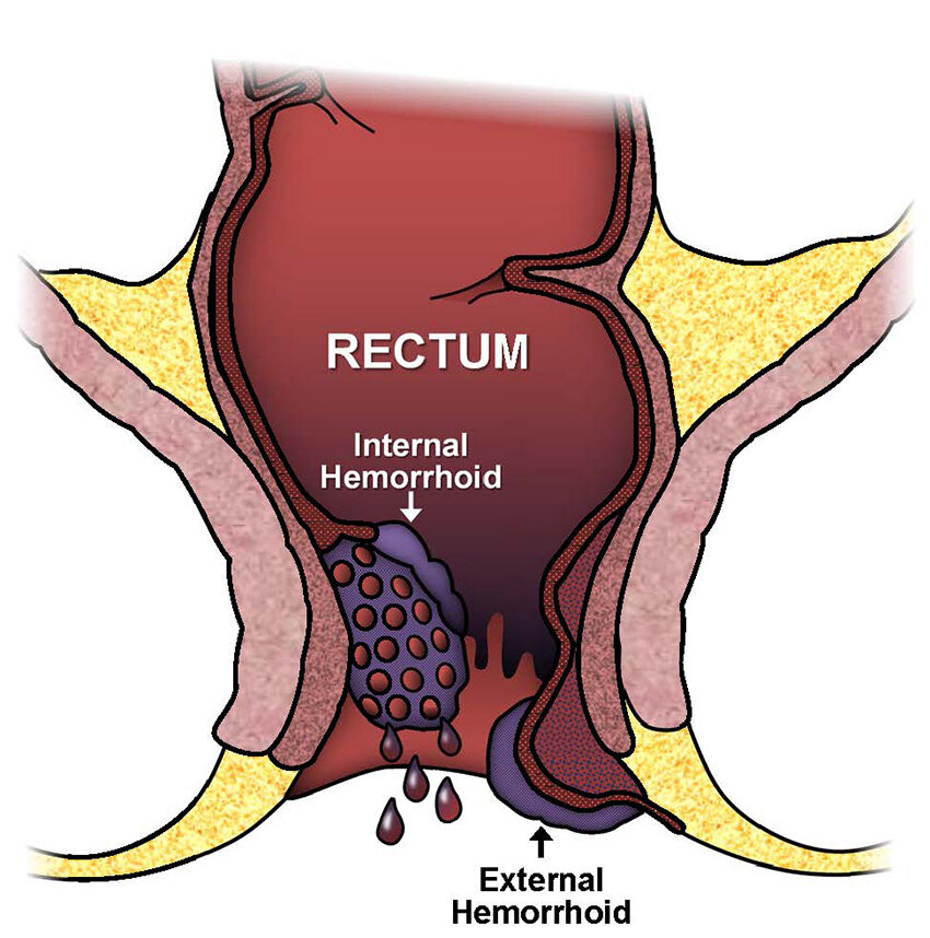 Haemorrhoids — Dr Terence Chua · General Surgeon And Colorectal Surgeon 