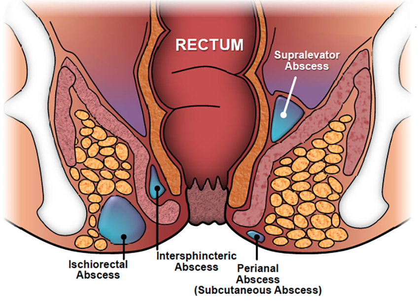 Perianal Abscess And Fistula — Dr Terence Chua · General Surgeon