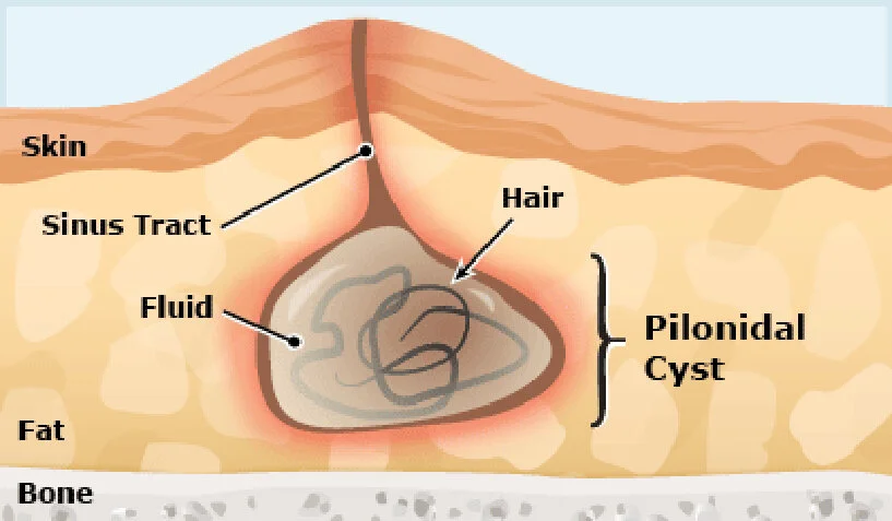 Pilonidal Sinus Disease — Dr Terence Chua · General Surgeon & Colorectal Surgeon · Brisbane Gold Coast Queensland Pilonidal Sinus Disease — Dr Terence Chua · General Surgeon & Colorectal Surgeon · Brisbane Gold Coast Queensland