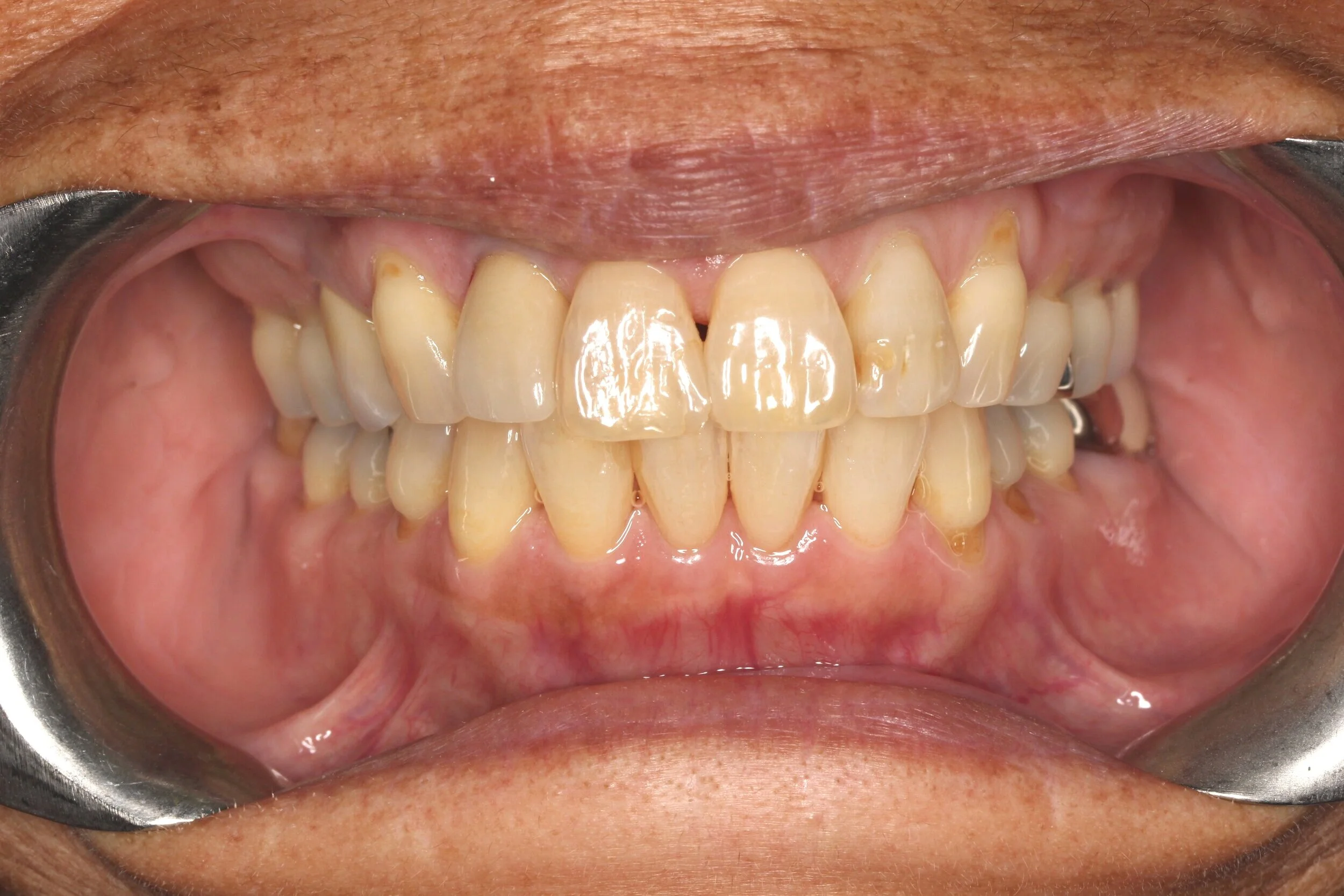 Ante+-After+Implant+supported+crown+placed-.jpg