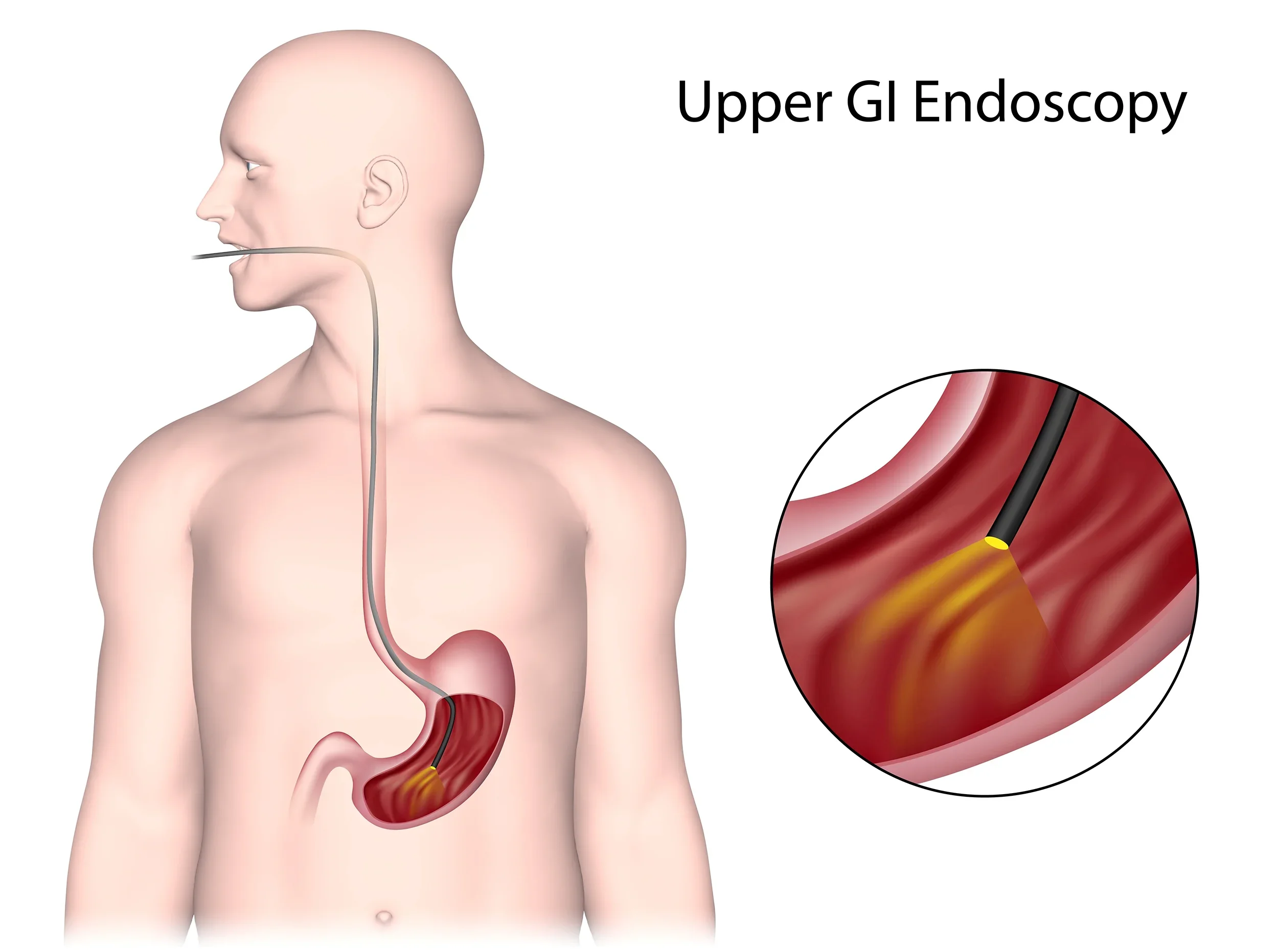 Diagram of a human upper gastrointestinal tract, highlighting the esophagus, stomach, and a magnified view of the esophagus and stomach lining.