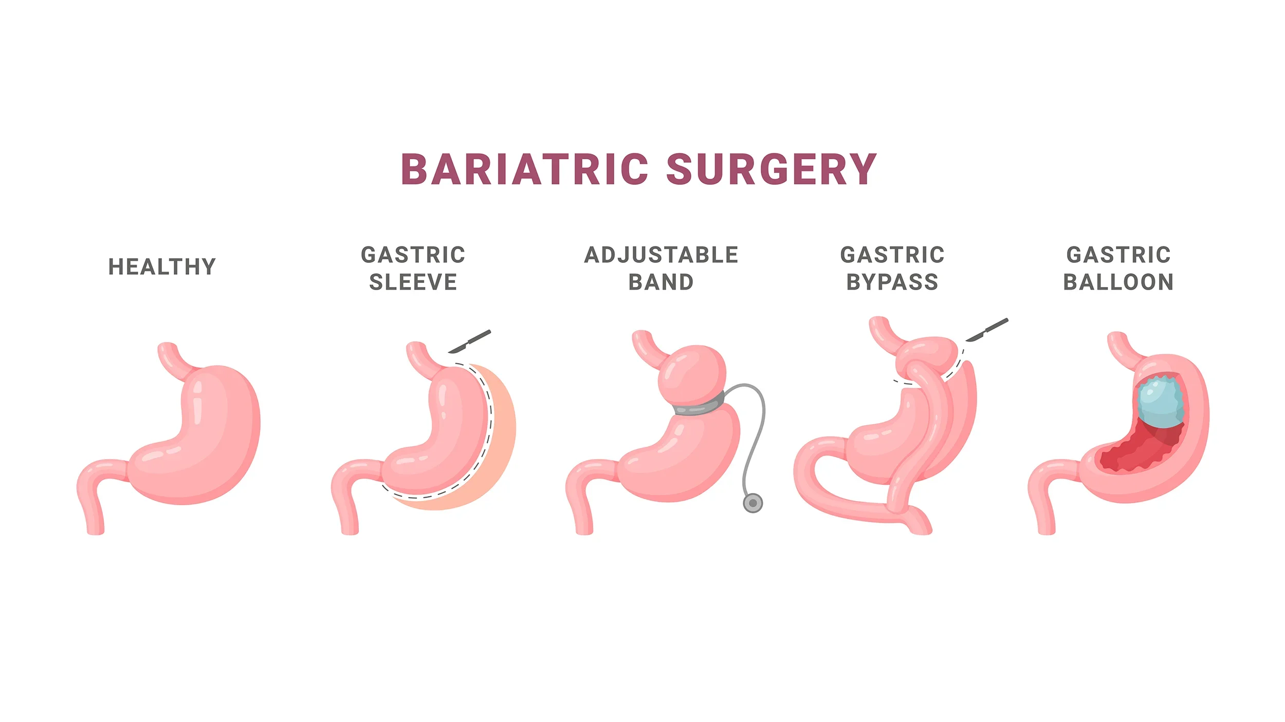 Series of illustrations demonstrating different types of bariatric surgery, including healthy stomach, gastric sleeve, adjustable band, gastric bypass, and gastric balloon.