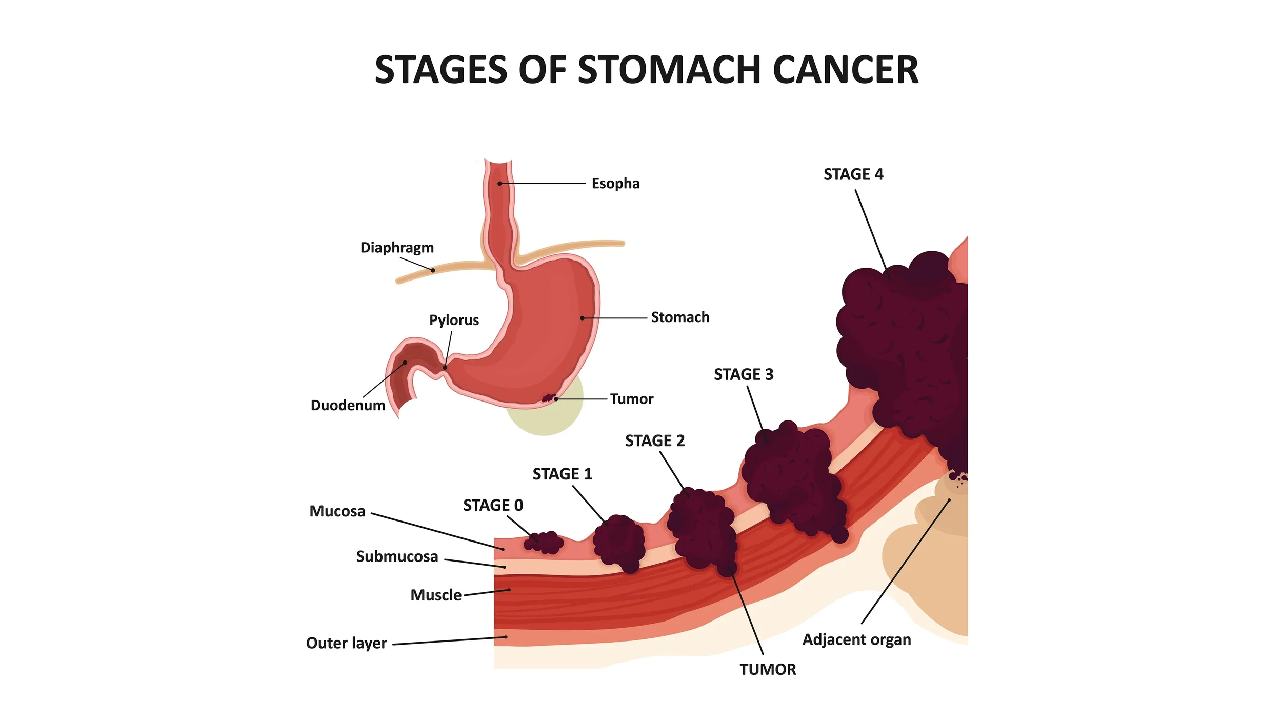 Diagram of stomach with labeled parts showing stages of stomach cancer, including esophagus, diaphragm, pylorus, duodenum, tumor, mucosa, submucosa, muscle, outer layer, and adjacent organ.