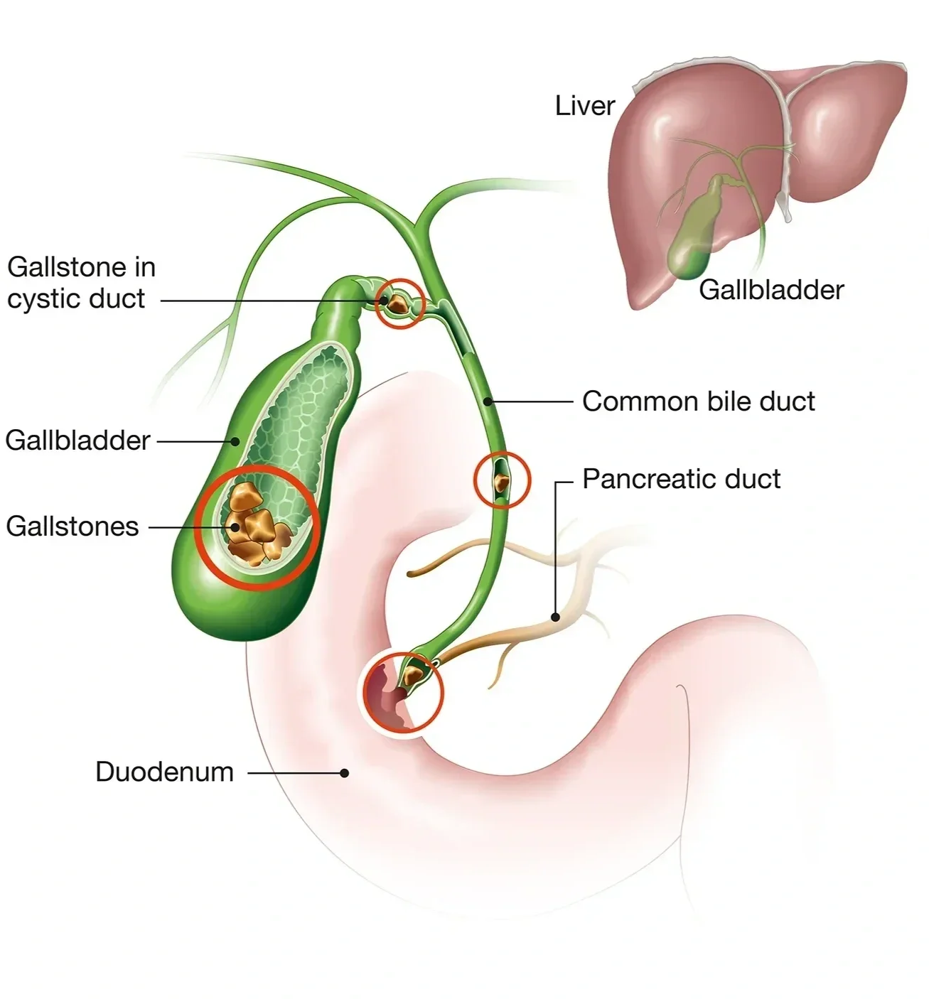 Diagram illustrating gallstone formation in the biliary system, showing gallstones in the gallbladder, cystic duct, and common bile duct, with labels for liver, gallbladder, gallstones, duodenum, pancreatic duct, and their anatomical connections.