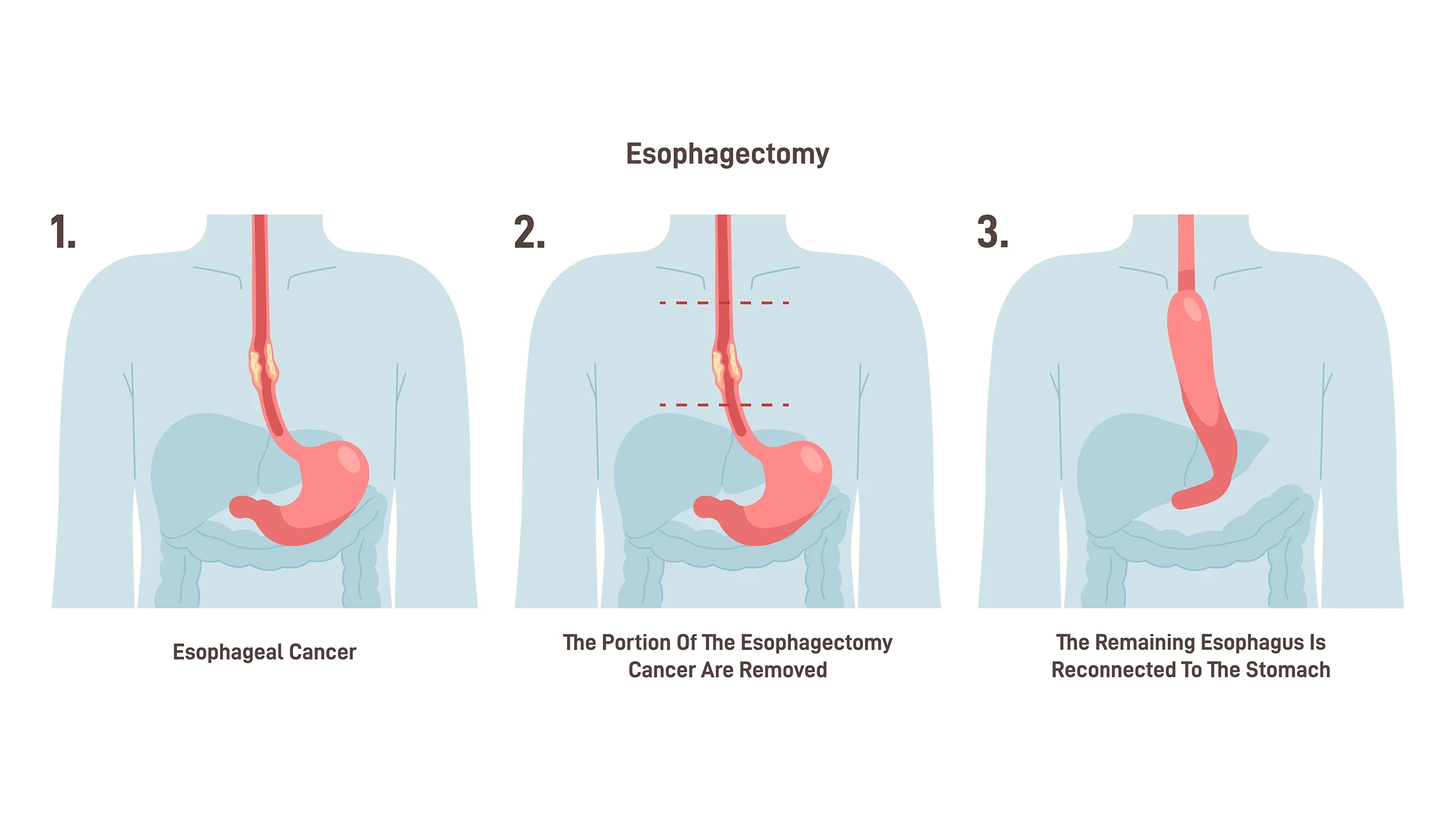 Diagram showing stages of esophagectomy, with three images: 1. Esophageal cancer, 2. The removed portion of the esophagus, 3. The remaining esophagus reconnected to the stomach.