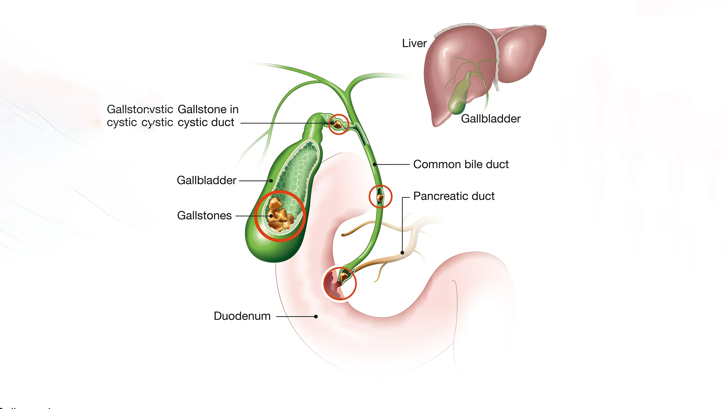 Diagram of the biliary system showing gallstones in the gallbladder and cystic duct, with labels for liver, gallbladder, cystic duct, common bile duct, pancreatic duct, and duodenum.